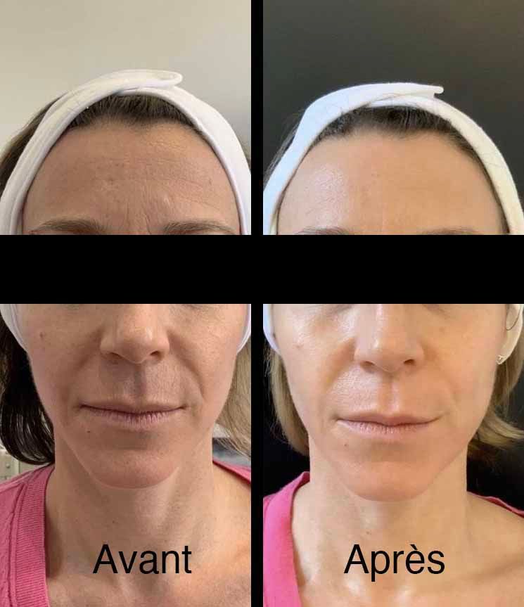 Photos côte à côte comparant les traitements de la peau du visage avant et après ; montrant une réduction des rides et une amélioration du teint.
