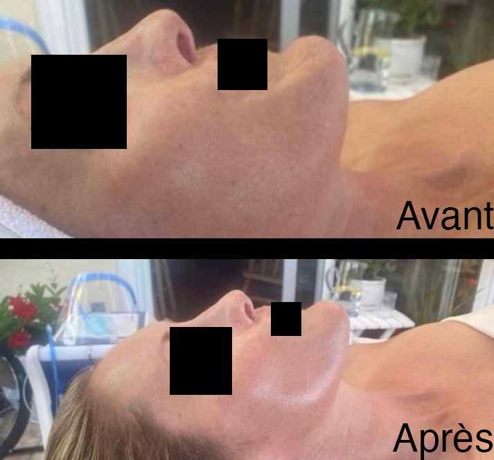 Comparaison côte à côte. Vue avant/après du visage. La peau paraît plus lisse sur la photo après.