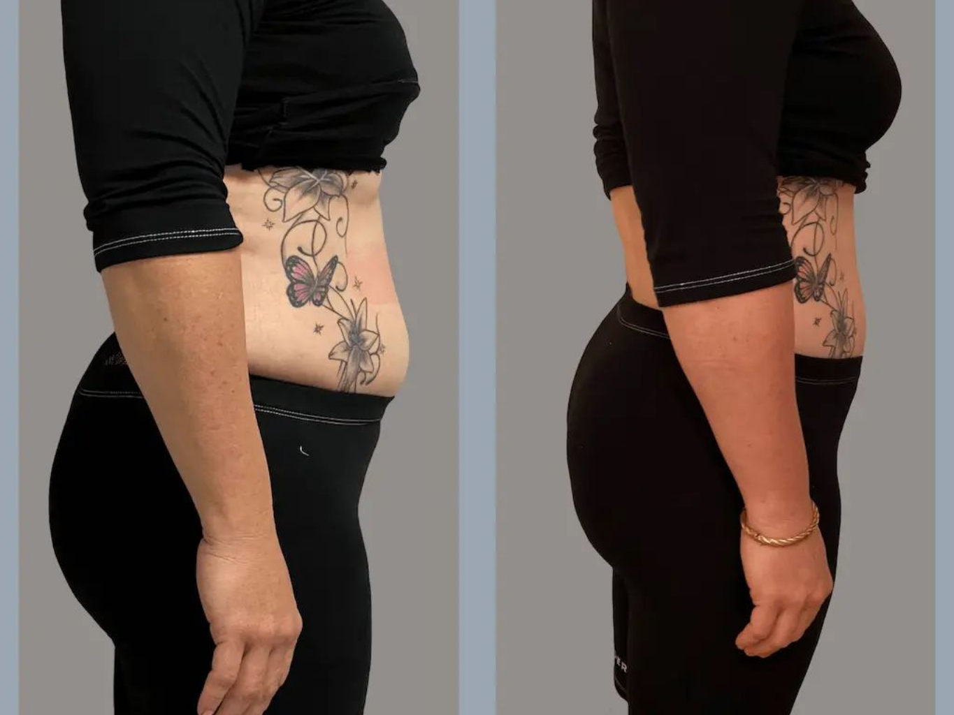 Avant/après, profil d'une personne. On observe une réduction de la graisse abdominale. La personne porte des vêtements noirs.