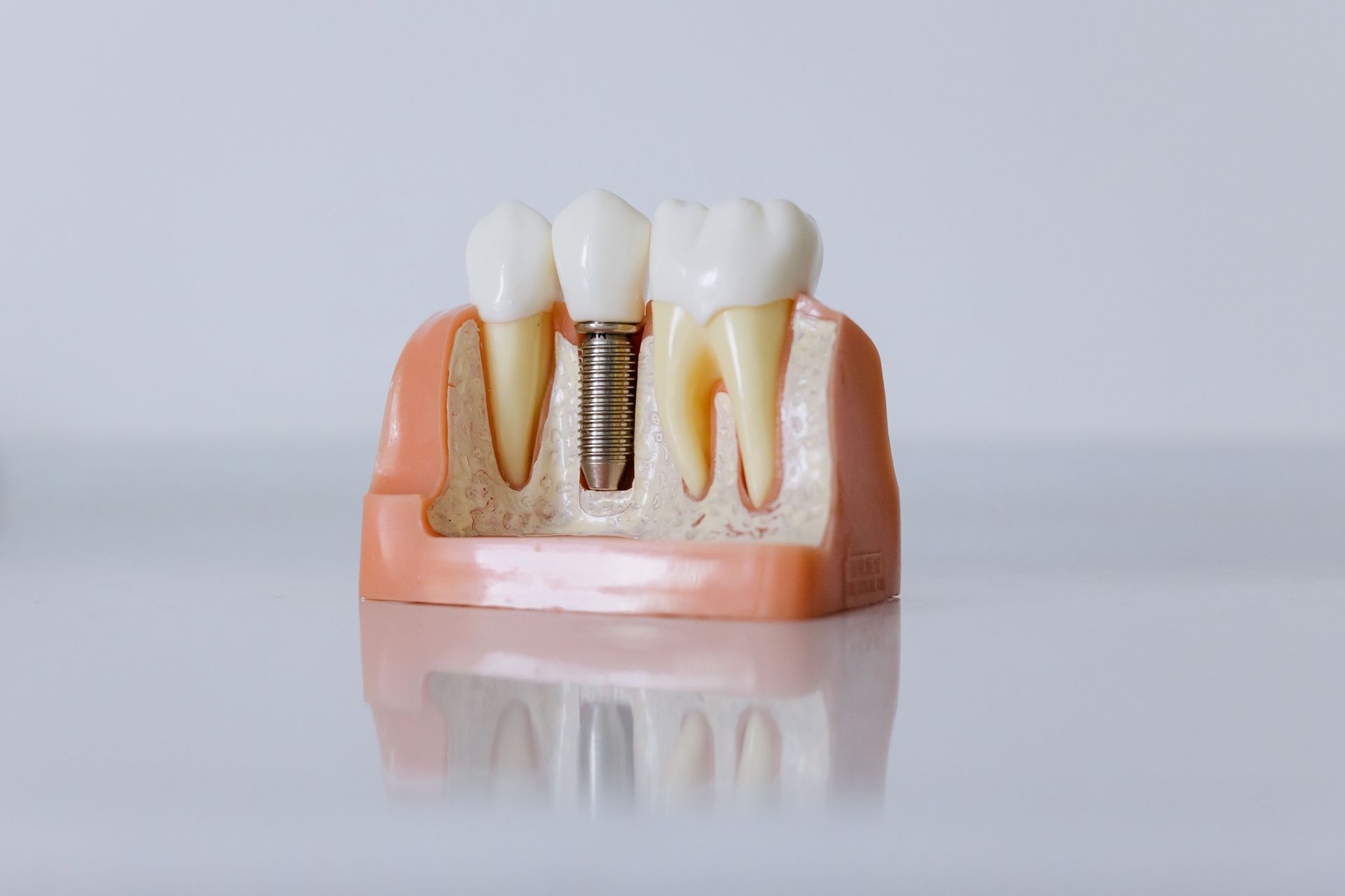 Modelo de implante dental con dos coronas blancas y tornillo metálico expuesto en base de encía rosada.