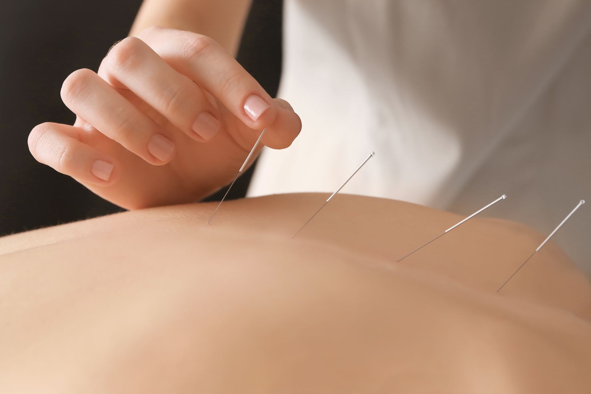 Main plaçant des aiguilles d'acupuncture dans la peau du dos