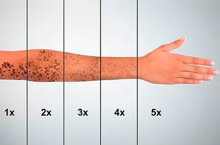 Brazo con distintos grados de manchas oscuras, dividido en secciones etiquetadas de 1x a 5x, posiblemente ilustrando la progresión de la condición de la piel.