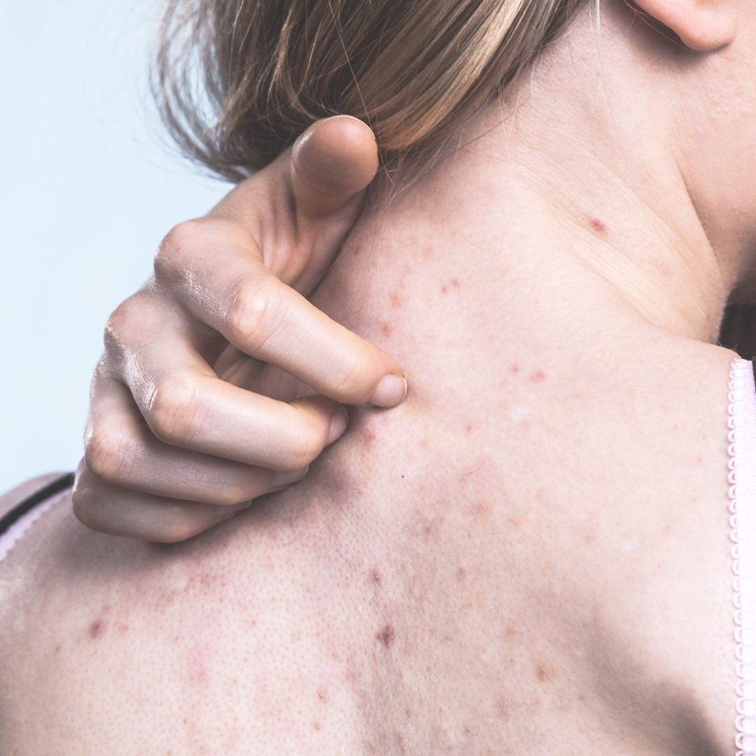 La espalda y el cuello de una persona con acné visible, la mano apuntando a una imperfección.