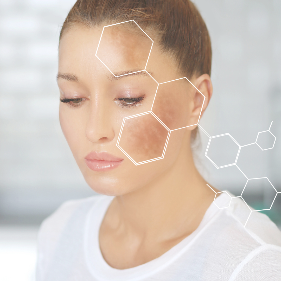 Mujer con melasma, un tipo de hiperpigmentación, en el rostro. Mira hacia abajo, con una superposición gráfica blanca.