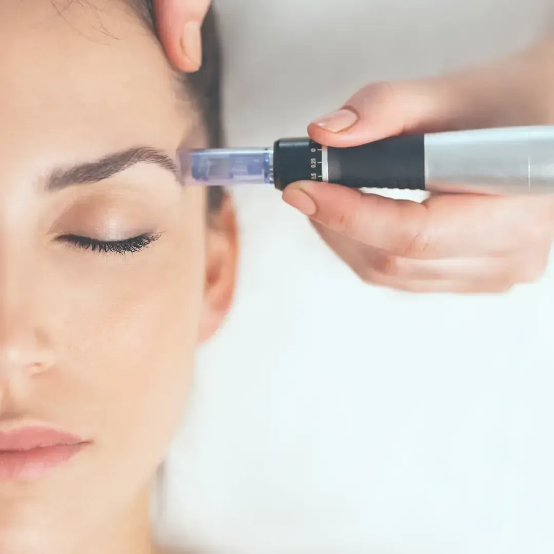 Rostro de una mujer recibiendo tratamiento de microagujas. Se le coloca un dispositivo con agujas diminutas cerca de la frente. Tiene los ojos cerrados.