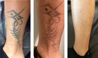 Progreso de la eliminación de un tatuaje en una pierna: tatuaje inicial, tatuaje desvanecido después de los tratamientos y piel limpia.