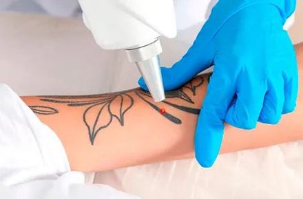 Una persona con guantes azules usa un láser para eliminar un tatuaje en el brazo de otra persona. El tatuaje es un diseño floral negro.