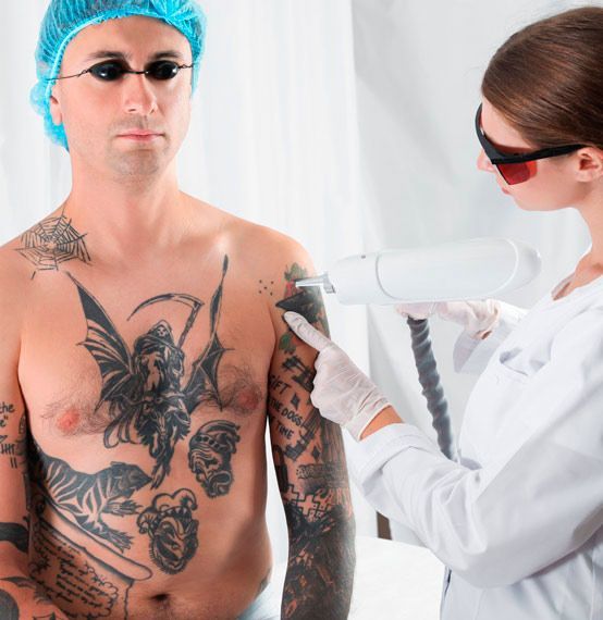 Una persona se somete a una eliminación de tatuaje en el hombro. Un profesional médico utiliza un dispositivo láser. Ambos usan gafas protectoras.