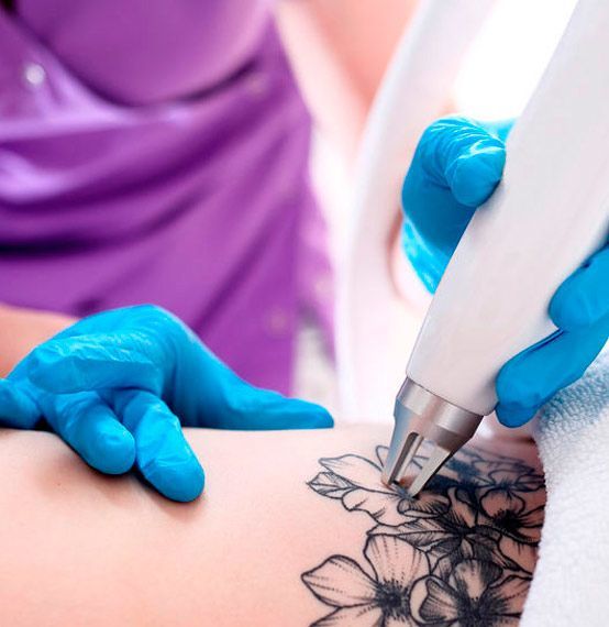 Una persona se somete a la eliminación de un tatuaje con láser. Una mano enguantada opera un dispositivo láser sobre un tatuaje de flores y hojas.