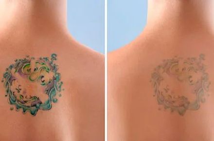 Antes y después de la espalda de una persona con un tatuaje colorido, que muestra su desvanecimiento después de los tratamientos de eliminación con láser.