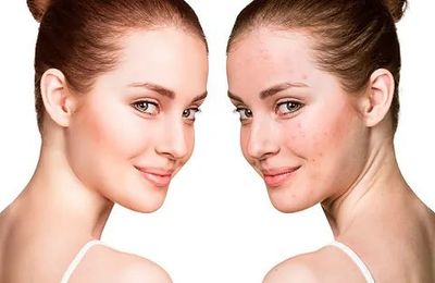 Comparación de una mujer con piel limpia (izquierda) y con piel con imperfecciones (derecha). En ambas se la ve sonriendo.