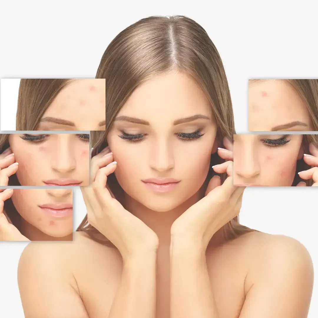 Mujer de piel clara rodeada de pequeñas imágenes de su rostro con acné.