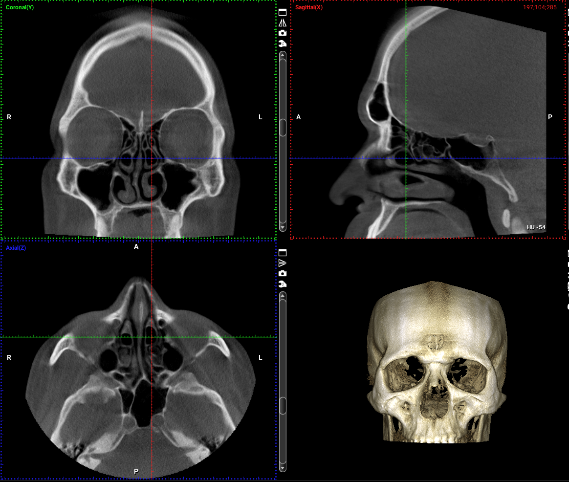 Digitale Volumentomographie (DVT) - DVT-Bilder eines Patienten