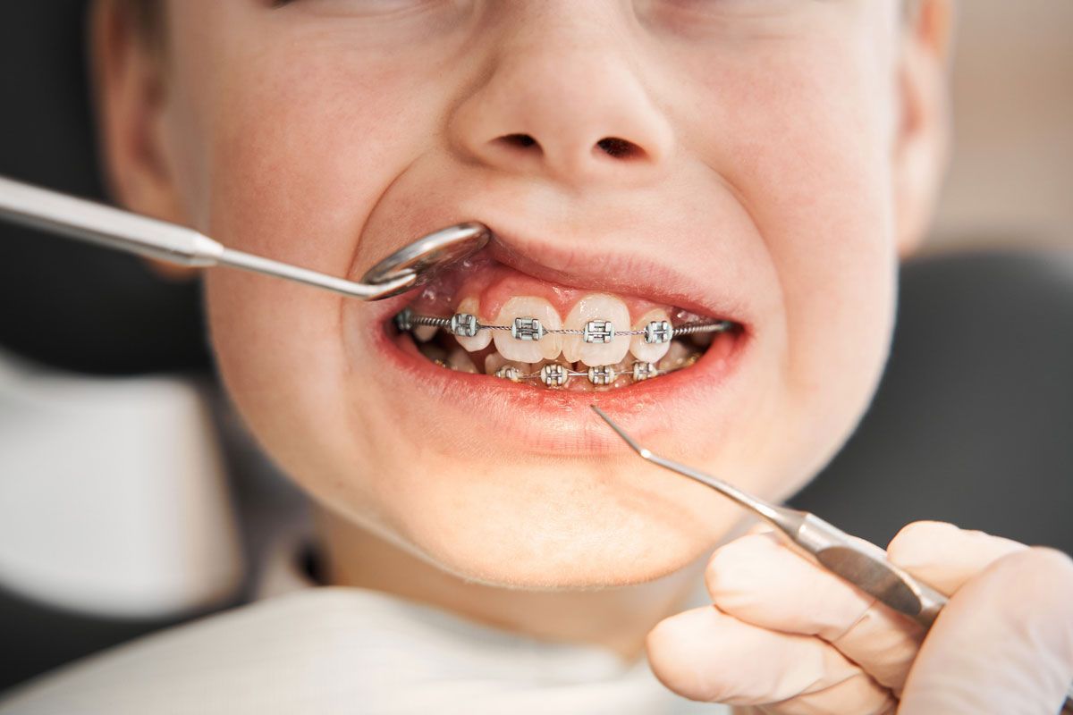 A un niño pequeño con aparatos ortopédicos le examinan los dientes un dentista.