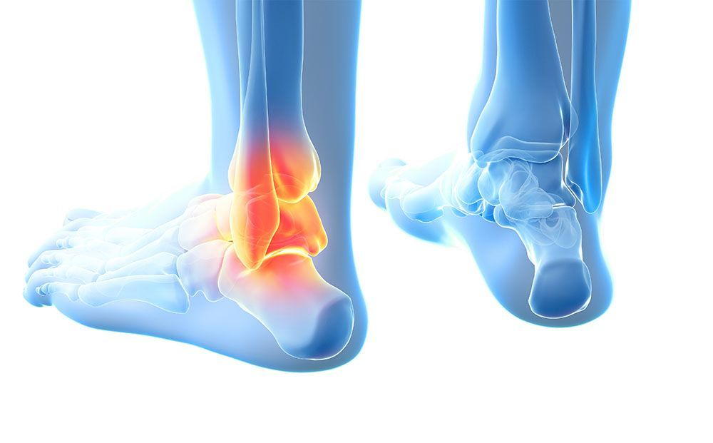 Eine 3D-Darstellung des Fußes einer Person mit einer Knöchelverletzung.