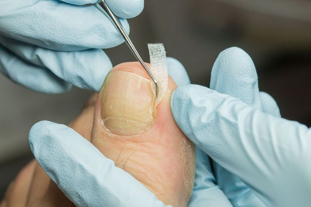 Behandschuhte Hände halten einen Fuss, an dem ein blau beleuchtetes Behandlungsgerät in der Nähe des Knöchels angebracht ist.
