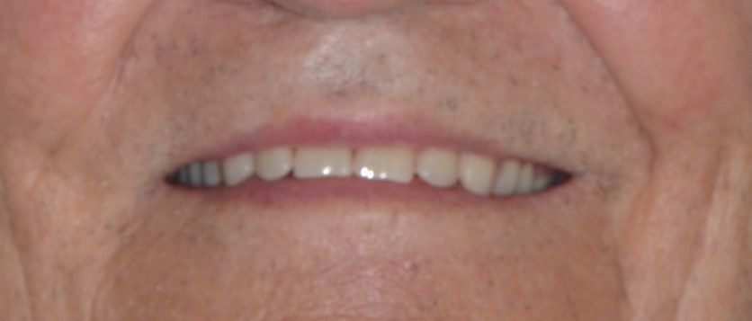 Eine Nahaufnahme des Mundes einer Person mit weißen Zähnen. Dentaltechnik Claudia Meier