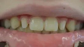 Eine Nahaufnahme der Zähne und des Mundes einer Person. Dentaltechnik Claudia Meier