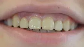 Eine Nahaufnahme des Mundes einer Person mit weißen Zähnen. Dentaltechnik Claudia Meier