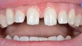 Eine Nahaufnahme der Zähne und des Mundes einer Person. Dentaltechnik Claudia Meier