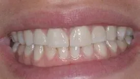 Eine Nahaufnahme des Mundes einer Person mit weißen Zähnen. Dentaltechnik Claudia Meier