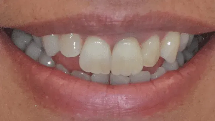 Eine Nahaufnahme des Mundes einer Person mit weißen Zähnen. Dentaltechnik Claudia Meier