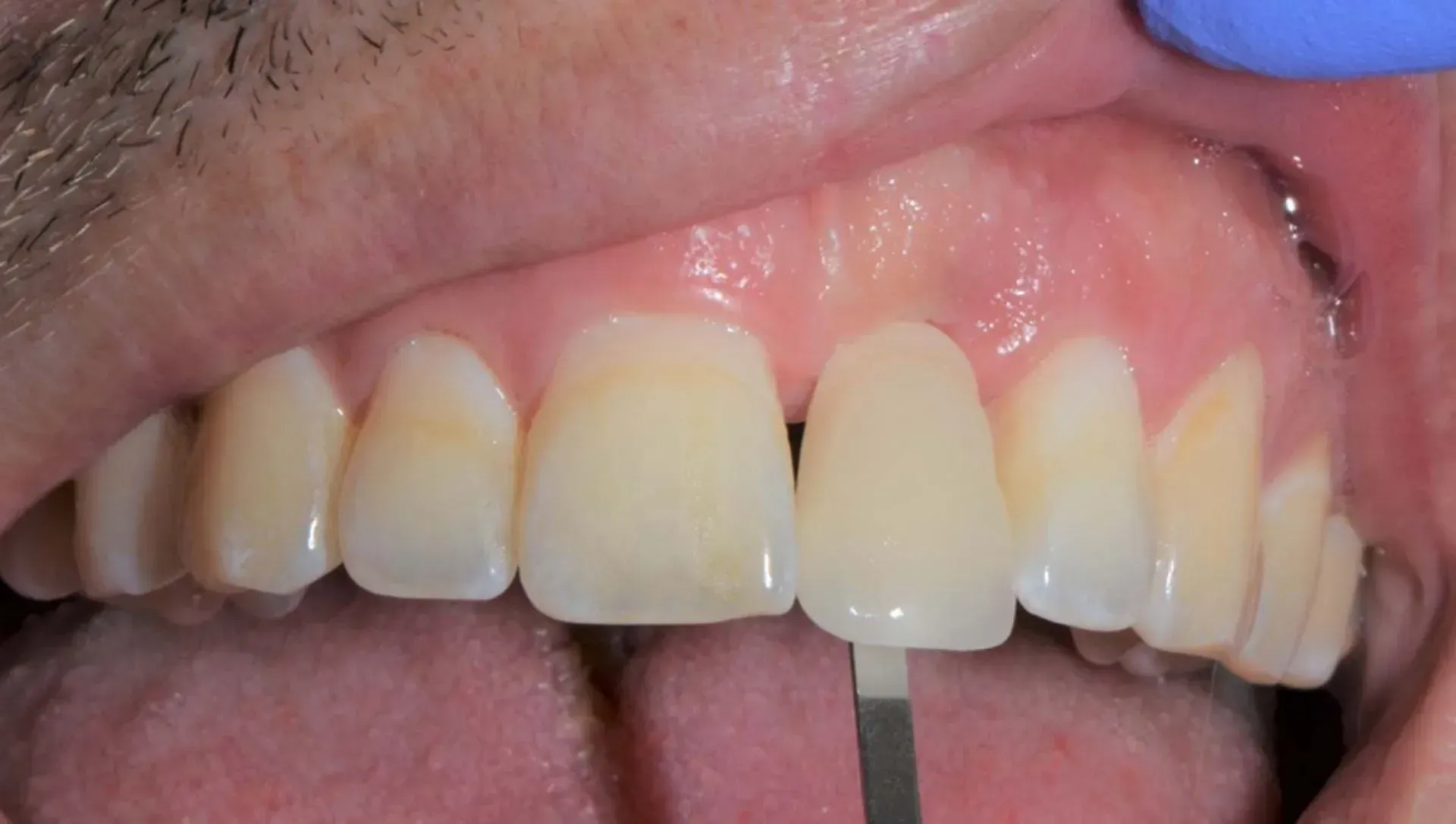 Eine Nahaufnahme der Zähne und des Mundes einer Person. Dentaltechnik Claudia Meier