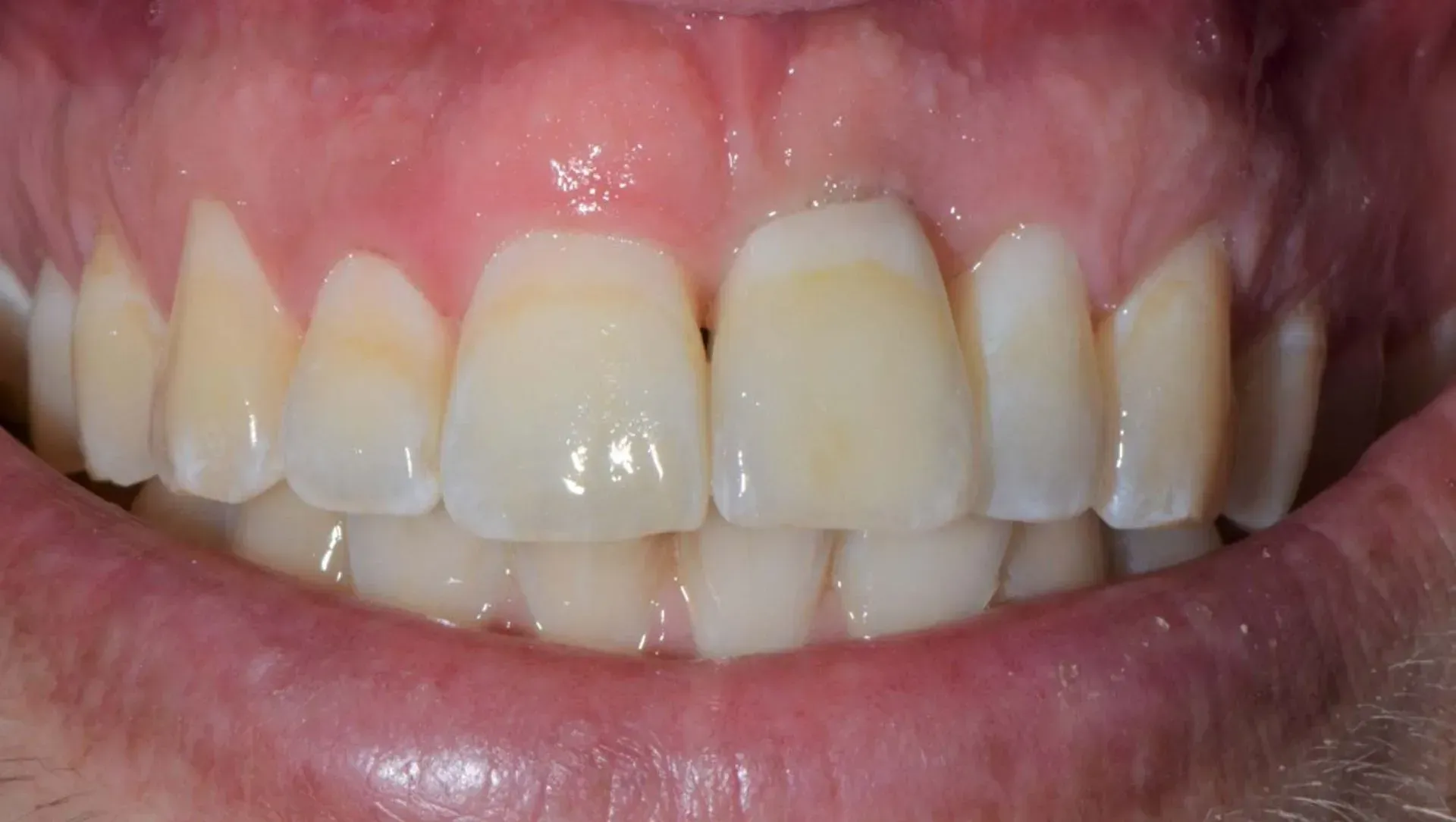 Eine Nahaufnahme des Mundes einer Person mit weißen Zähnen. Dentaltechnik Claudia Meier