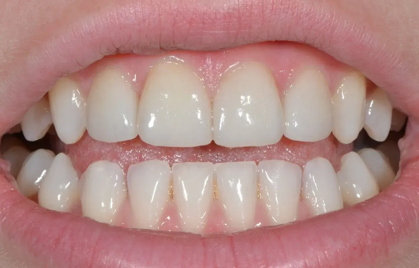 Eine Nahaufnahme des Mundes einer Person mit weißen Zähnen. Dentaltechnik Claudia Meier