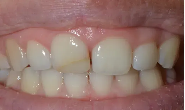 Eine Nahaufnahme des Mundes einer Person mit weißen Zähnen. Dentaltechnik Claudia Meier