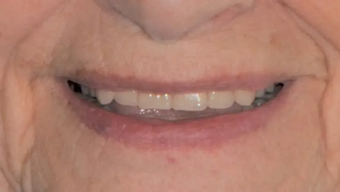 Eine Nahaufnahme des Mundes einer Person mit weißen Zähnen. Dentaltechnik Claudia Meier