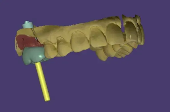 Ein 3D-Modell eines Zahns, an dem ein gelber Stab befestigt ist. Dentaltechnik Claudia Meier
