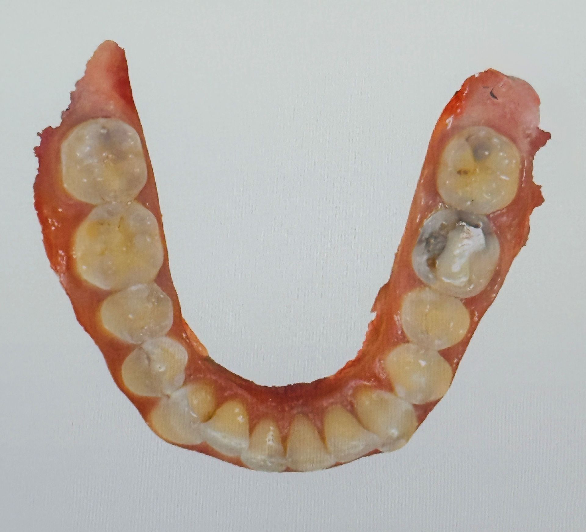 Menschlicher Unterkiefer mit Zähnen, der Zahnersatz und Karies aufweist.