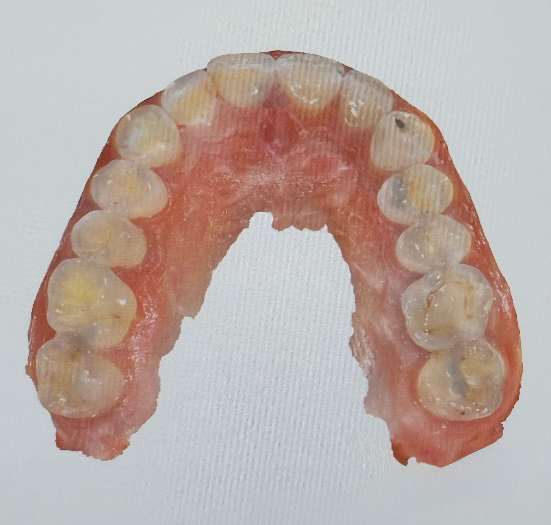 Oberer Zahnbogen mit vergilbten Zähnen im rosa Zahnfleisch, wobei ein mittlerer Zahn fehlt.