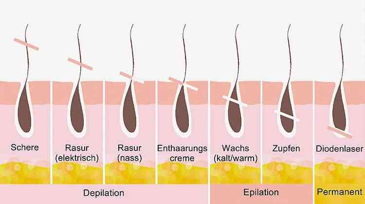 Abbildung Haarwurzel und Haarentfernungstechniken