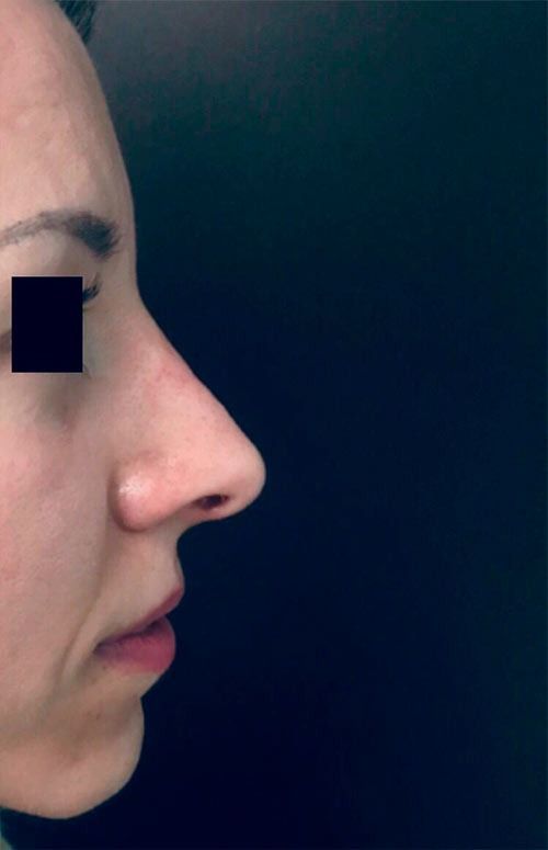 Un primer plano de la nariz de una mujer con un cuadrado que cubre sus ojos.