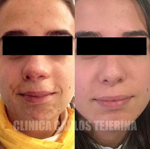 Una foto de antes y después del rostro de una mujer.