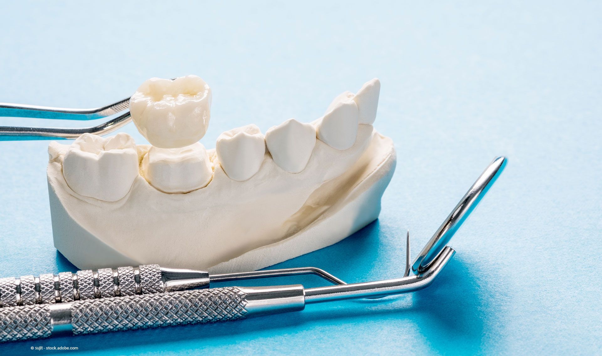 Implantat mit Schraube