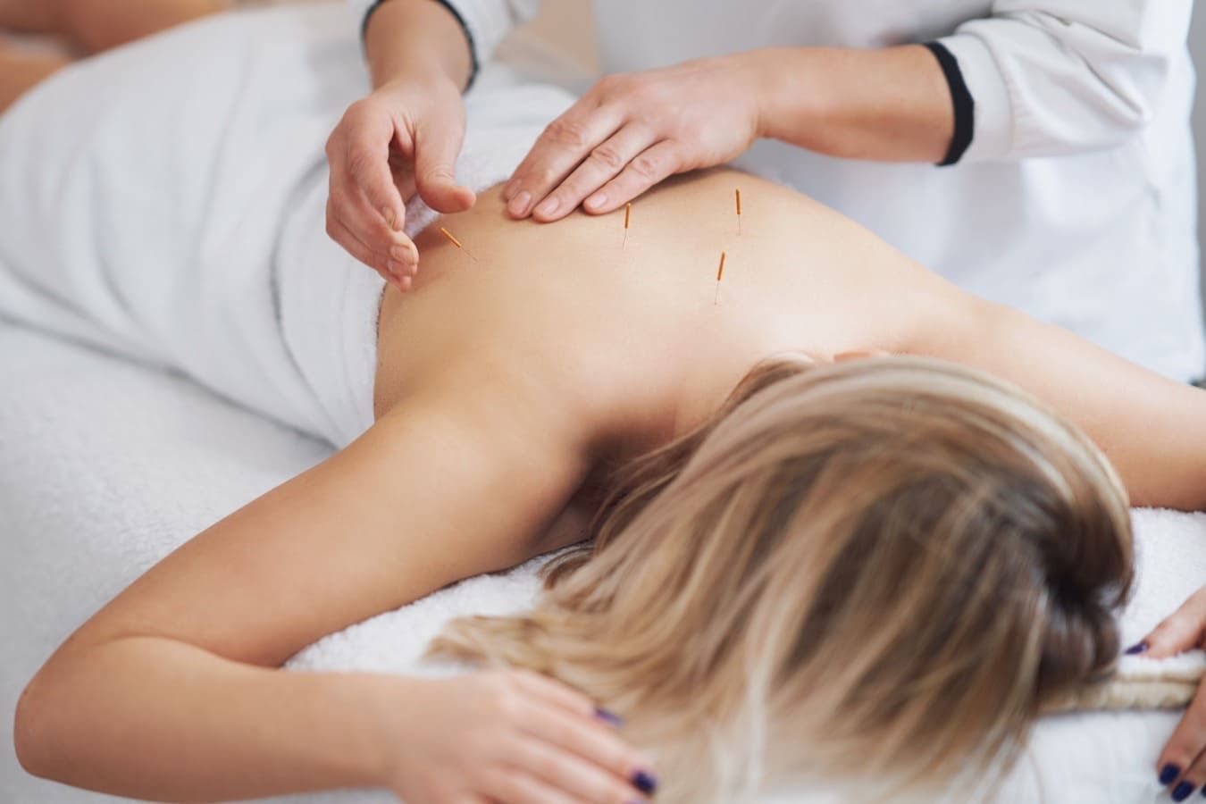 Una mujer está recibiendo un tratamiento de acupuntura en la espalda.