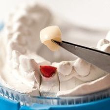 Cabinet Dentaire - Orsières - Dent abimée