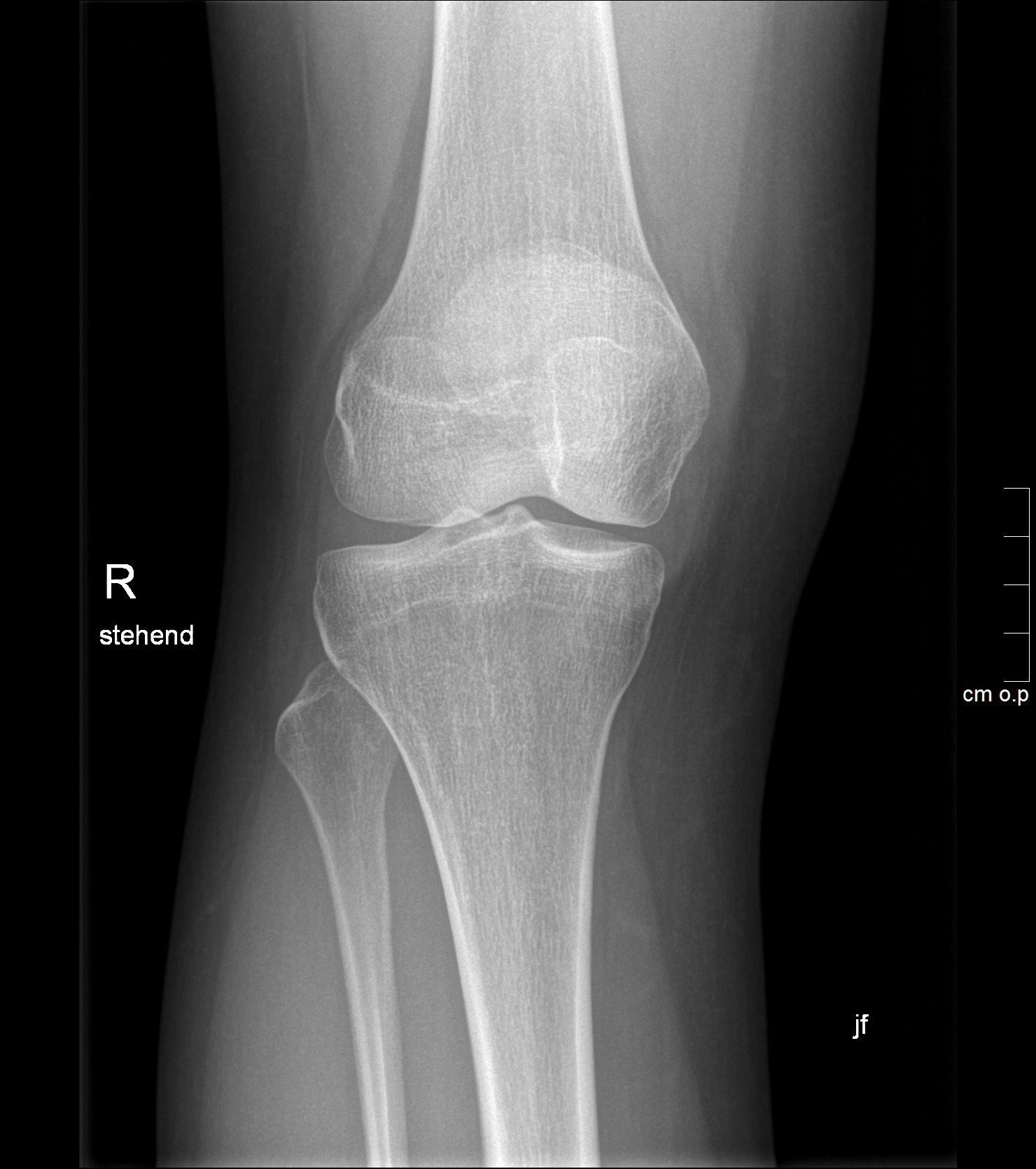 Anteroposteriore Röntgenaufnahme des rechten Knies, die Femur, Tibia, Fibula und Patella in Schwarz-Weiß zeigt.