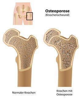 Vergleich eines gesunden menschlichen Hüftknochens mit einem von Osteoporose betroffenen Knochen, der eine erhöhte Knochenporosität zeigt.