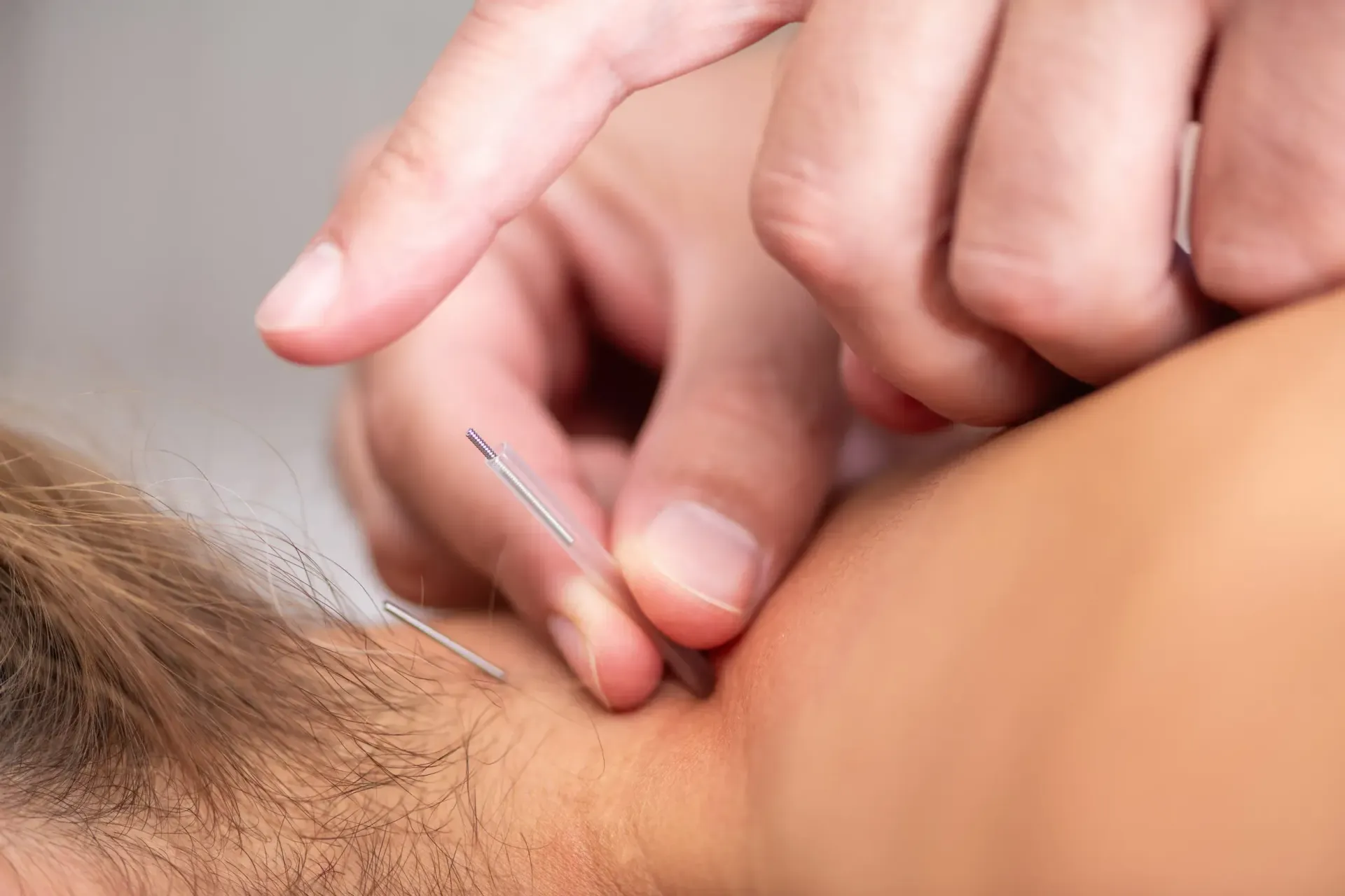 Aplicaci&oacute;n de punci&oacute;n seca en hombro por fisioterapeuta en un entorno cl&iacute;nico.