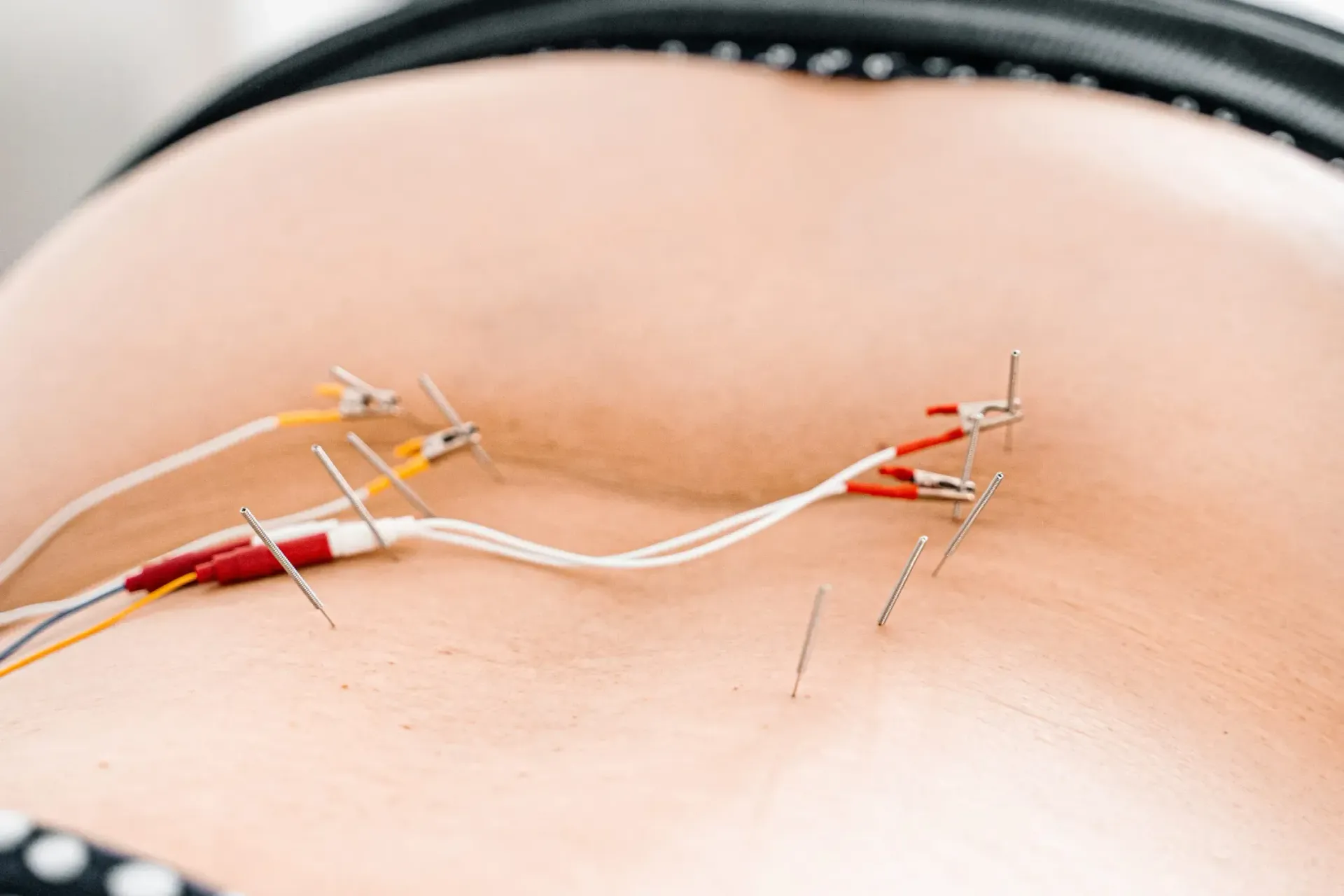 Detalle de aguja fina utilizada en punci&oacute;n seca para tratar puntos gatillo.