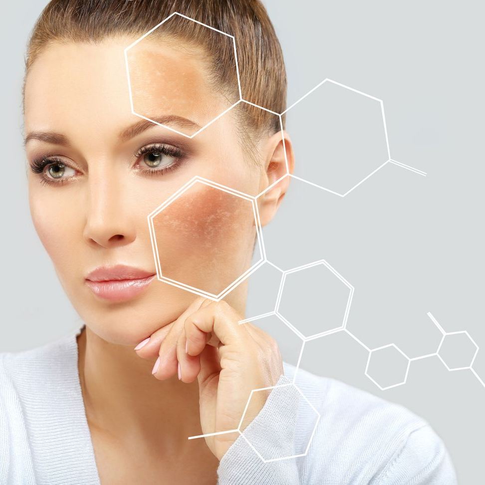 Femme atteinte de mélasma, une affection cutanée du visage.