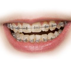 Festsitzende Spangen