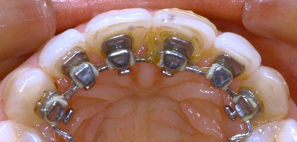 Lingualtechnik Ende der Behandlung