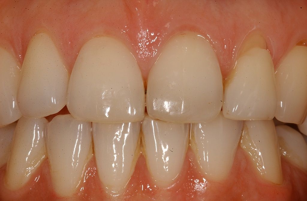 Lingualtechnik Endergebniss