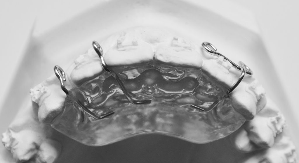 Clip-over bei Festsitz.Apparatur