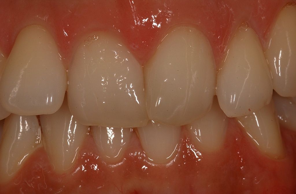 Lingualtechnik Anfangssituation